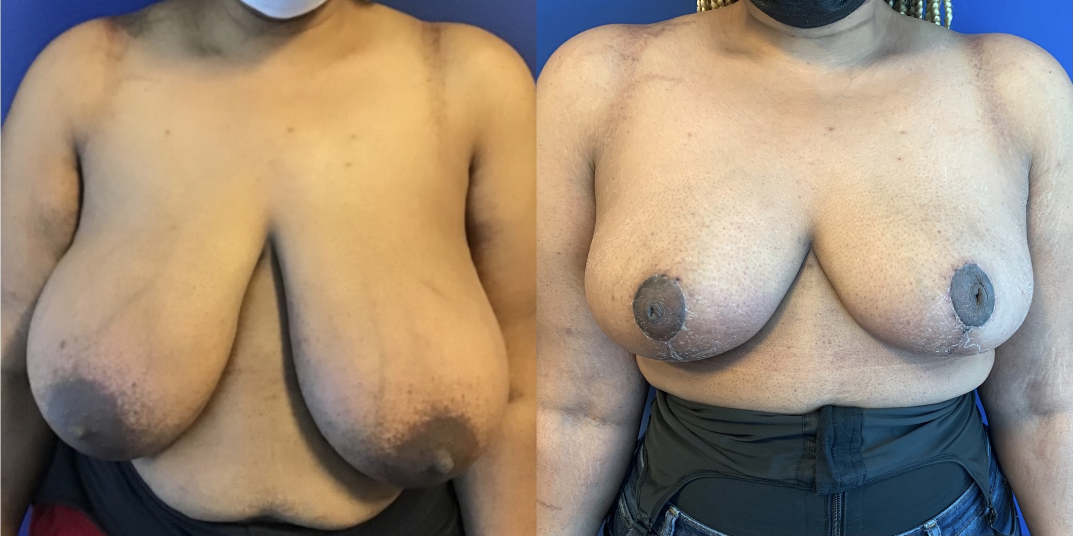Before and after comparison of breast surgery.