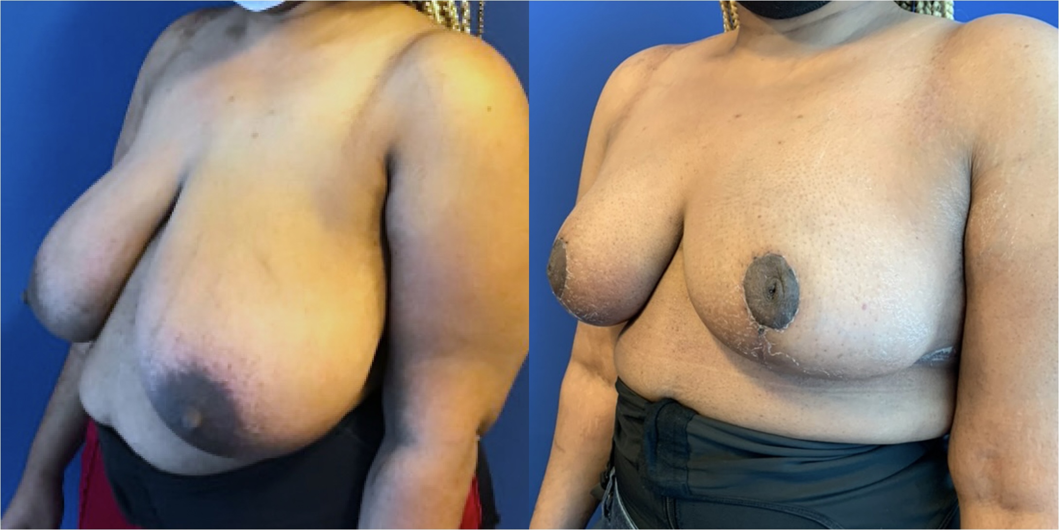 Before and after comparison of a breast reduction surgery.