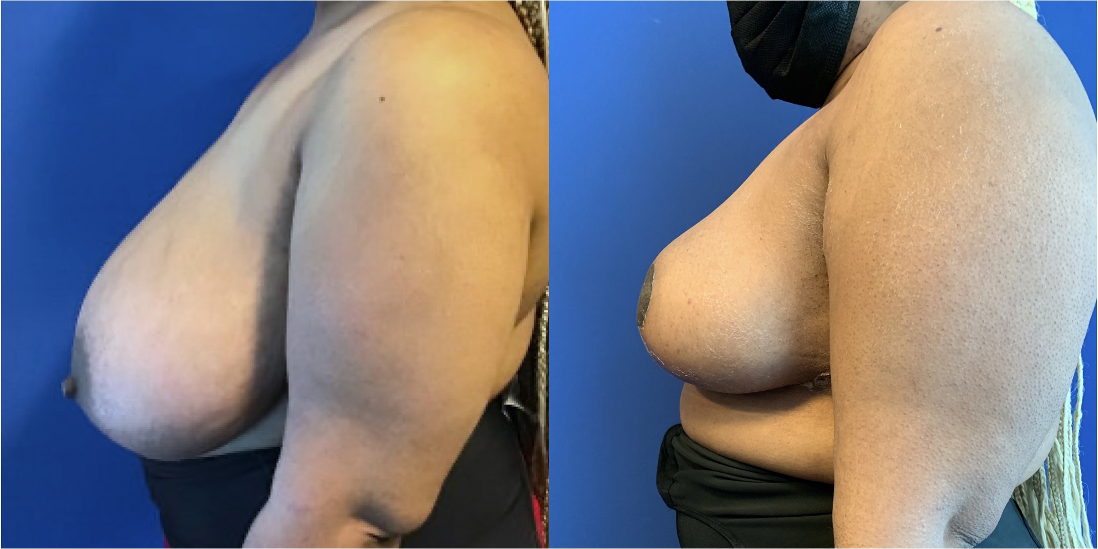 Before and after comparison of an arm, possibly illustrating the results of a weight loss or fitness program.