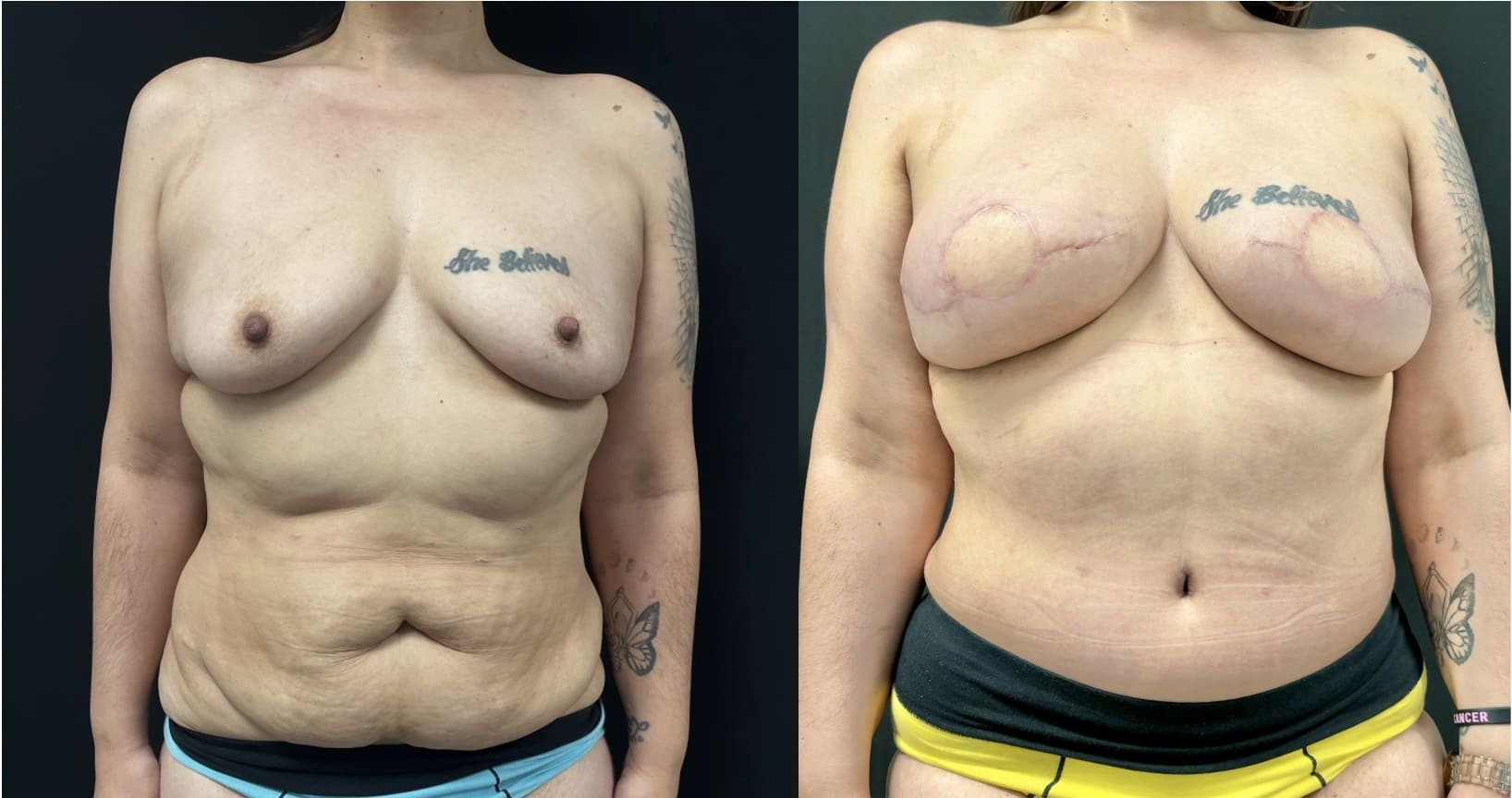 Side-by-side comparison of a person's upper body before and after breast surgery, showing changes in breast shape and scarring.