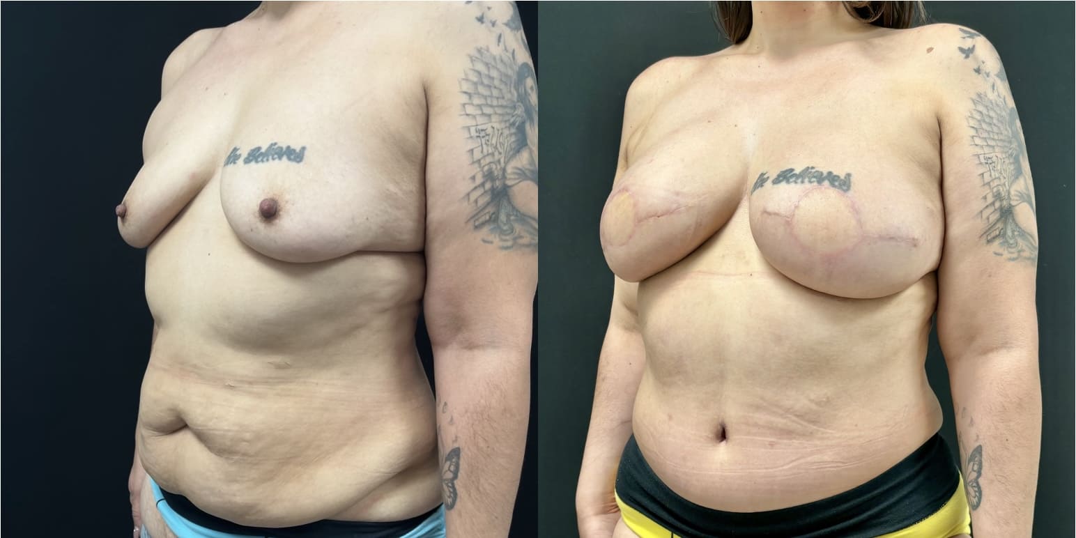 Side-by-side before and after photos show an individual with tattoos who has undergone breast augmentation or reconstruction surgery and body contouring.