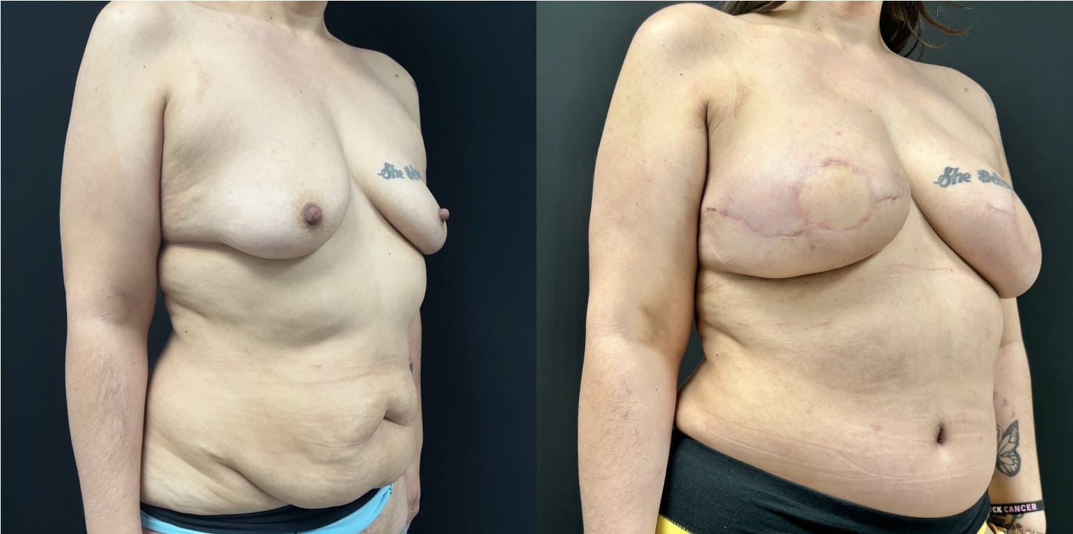 Side-by-side comparison of a person before and after breast reconstruction surgery, highlighting changes in breast shape and scarring. They are posing against a plain, dark background.