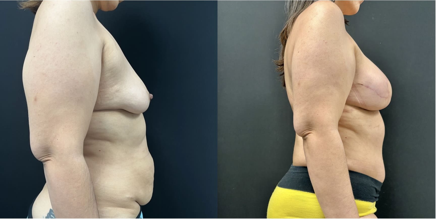 Side-by-side before-and-after images of a person showcasing body contouring and skin tightening results, with noticeable changes in arm and torso areas.