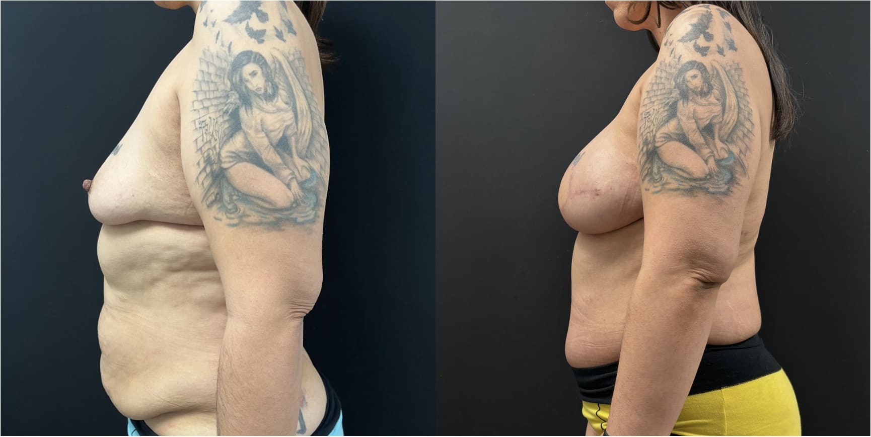 Side-by-side comparison of a torso before and after a medical procedure, showing a reduction in abdominal fat and improved skin tightness. Both images feature a detailed angel tattoo on the arm.