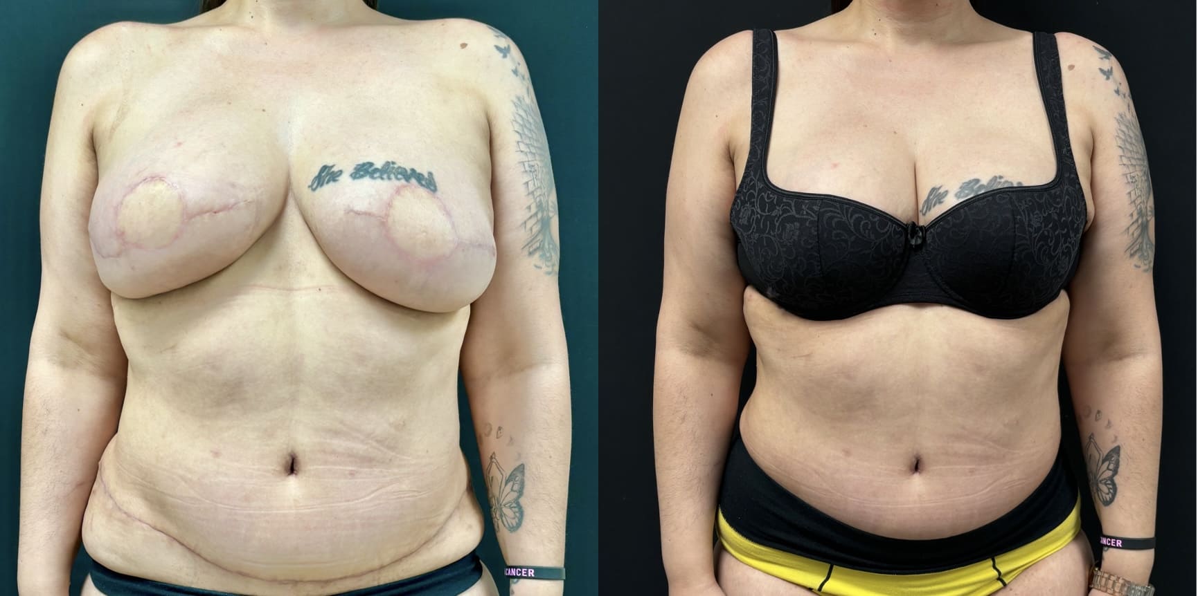 Before and after photos of a woman showing the results of breast reconstruction surgery. The left image shows scars on the chest, and the right image shows the woman wearing a bra.